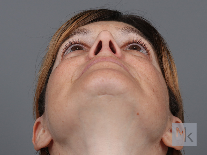 Rhinoplasty Before and After | Dr. Michael Kim