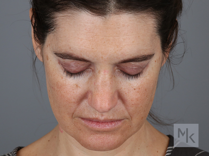 Rhinoplasty Before and After | Dr. Michael Kim
