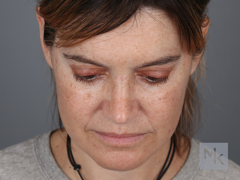 Rhinoplasty Before and After | Dr. Michael Kim