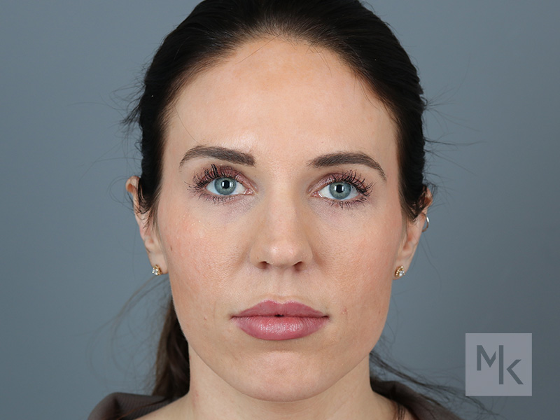 Rhinoplasty Before and After | Dr. Michael Kim