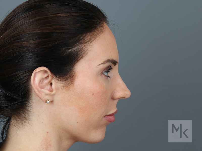 Rhinoplasty Before and After | Dr. Michael Kim