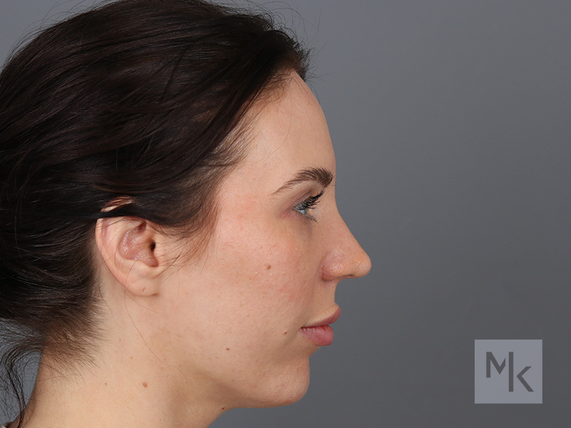 Rhinoplasty Before and After | Dr. Michael Kim