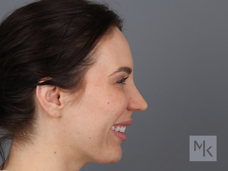 Rhinoplasty Before and After | Dr. Michael Kim