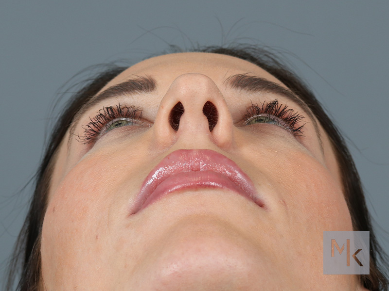 Rhinoplasty Before and After | Dr. Michael Kim