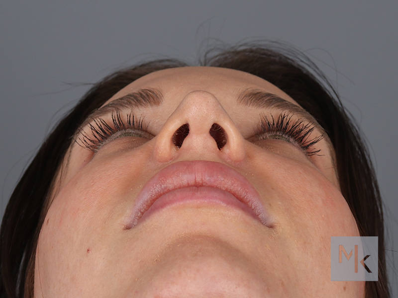 Rhinoplasty Before and After | Dr. Michael Kim