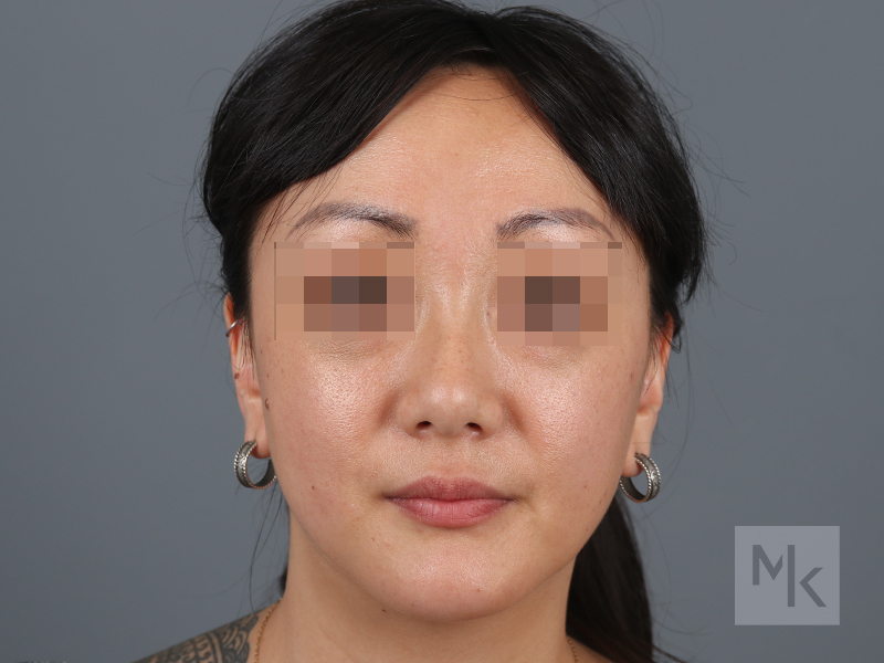 Rhinoplasty Before and After | Dr. Michael Kim