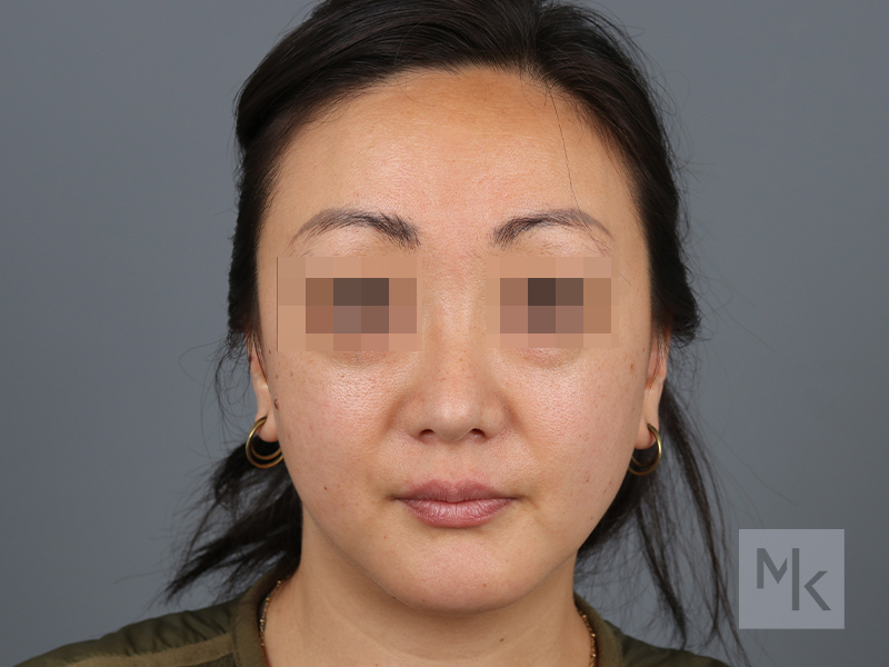 Rhinoplasty Before and After | Dr. Michael Kim