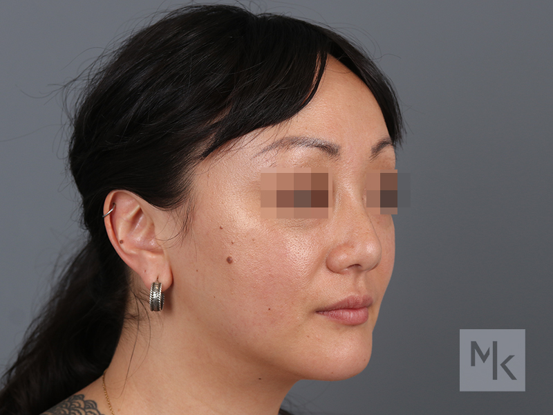 Rhinoplasty Before and After | Dr. Michael Kim