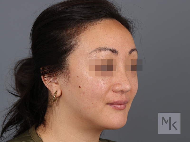 Rhinoplasty Before and After | Dr. Michael Kim