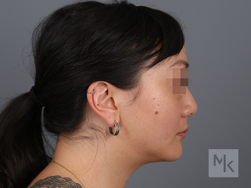 Rhinoplasty Before and After | Dr. Michael Kim