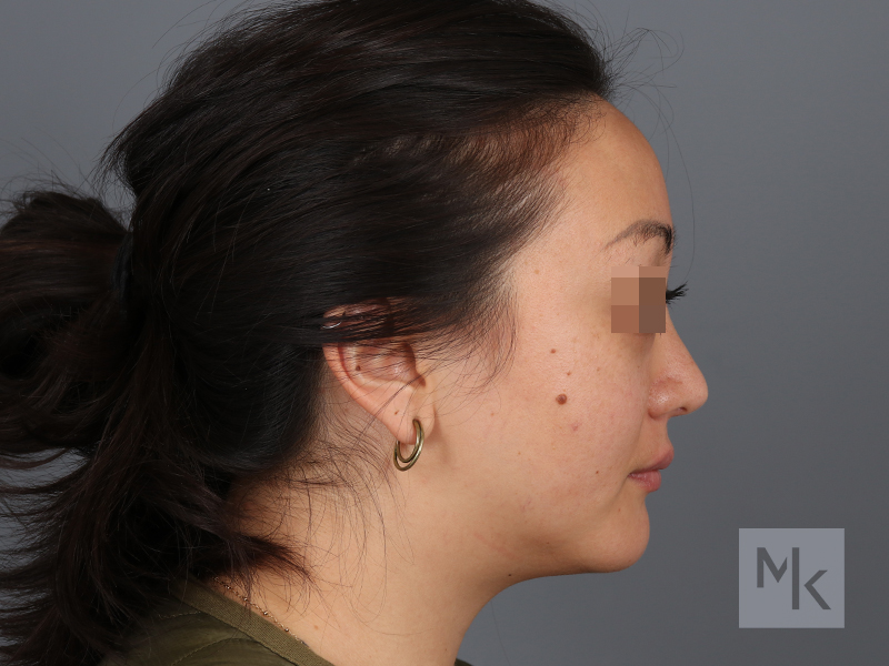 Rhinoplasty Before and After | Dr. Michael Kim