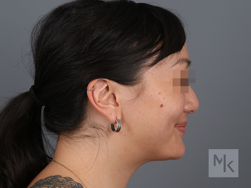 Rhinoplasty Before and After | Dr. Michael Kim