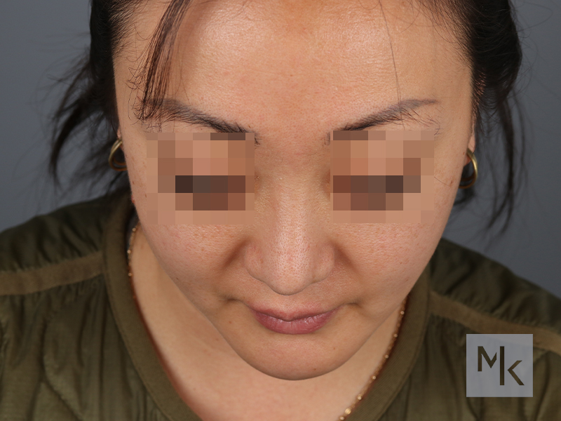Rhinoplasty Before and After | Dr. Michael Kim