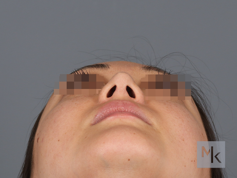 Rhinoplasty Before and After | Dr. Michael Kim