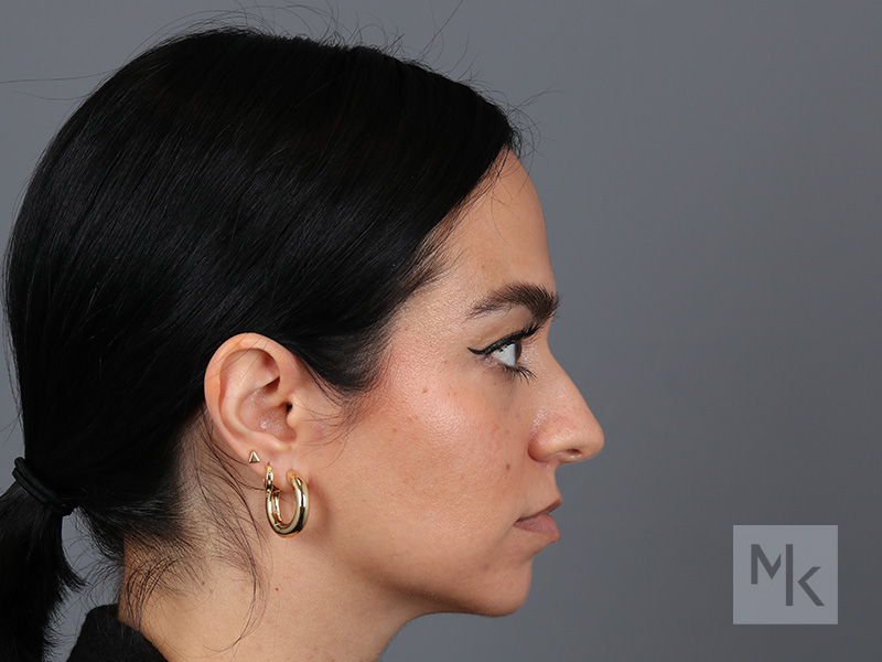 Rhinoplasty Before and After | Dr. Michael Kim