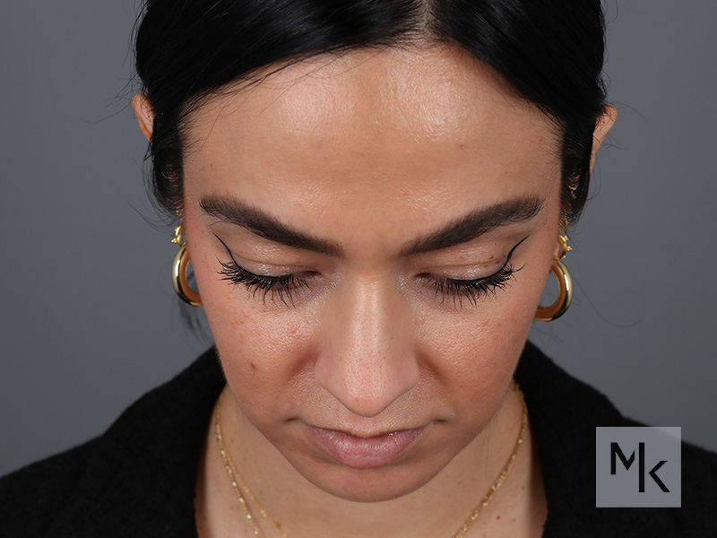 Rhinoplasty Before and After | Dr. Michael Kim