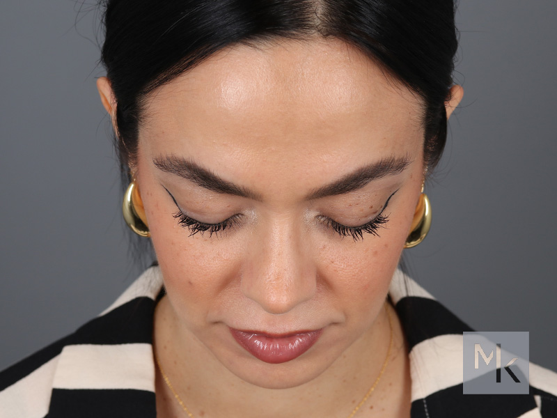 Rhinoplasty Before and After | Dr. Michael Kim