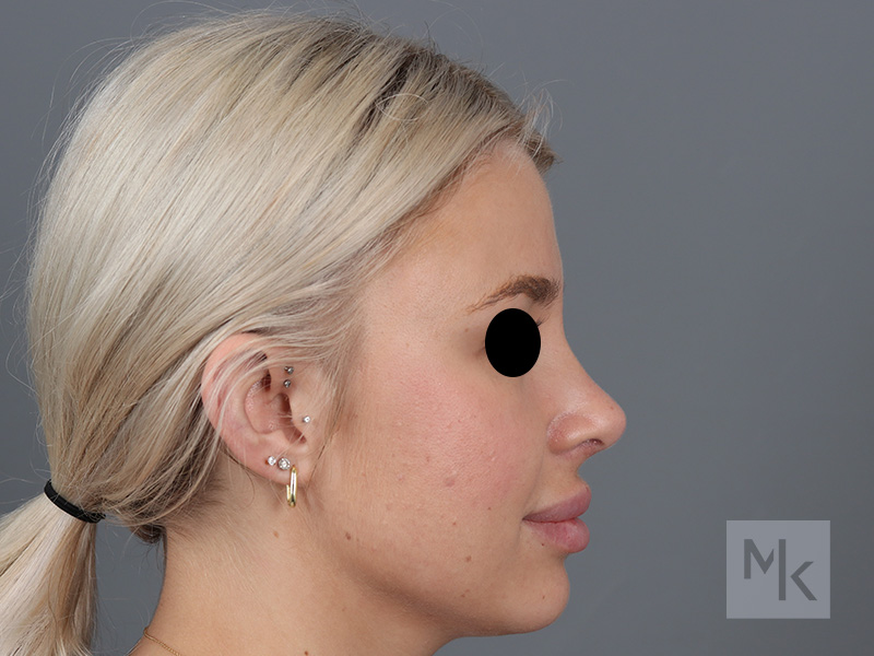 Rhinoplasty Before and After | Dr. Michael Kim