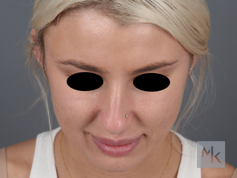 Rhinoplasty Before and After | Dr. Michael Kim
