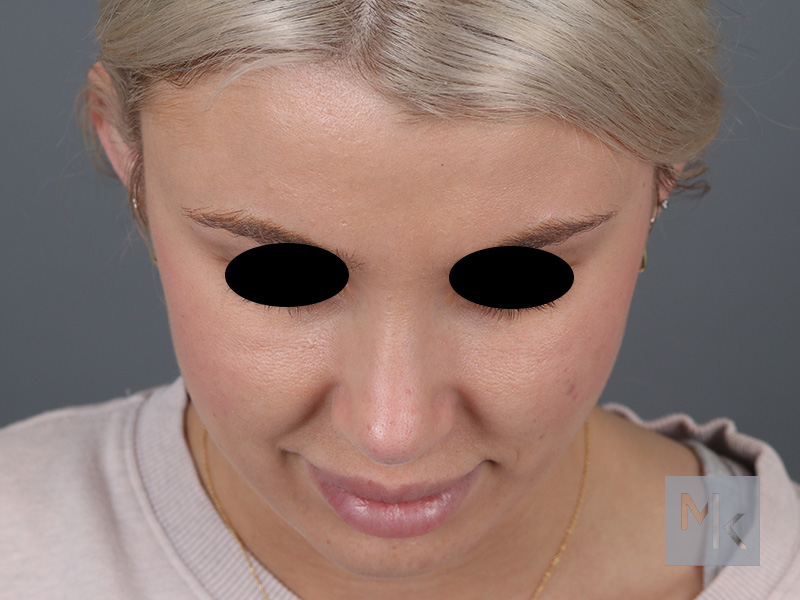 Rhinoplasty Before and After | Dr. Michael Kim