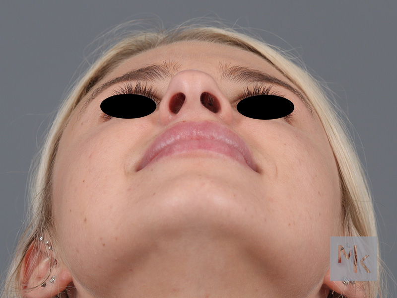 Rhinoplasty Before and After | Dr. Michael Kim