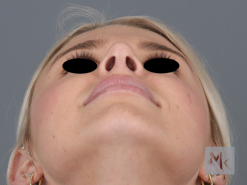 Rhinoplasty Before and After | Dr. Michael Kim