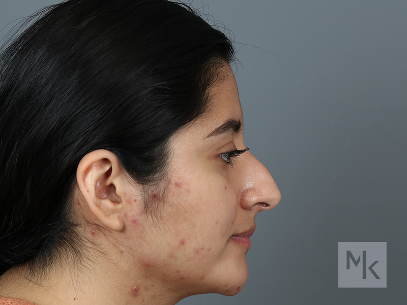 Rhinoplasty Before and After | Dr. Michael Kim