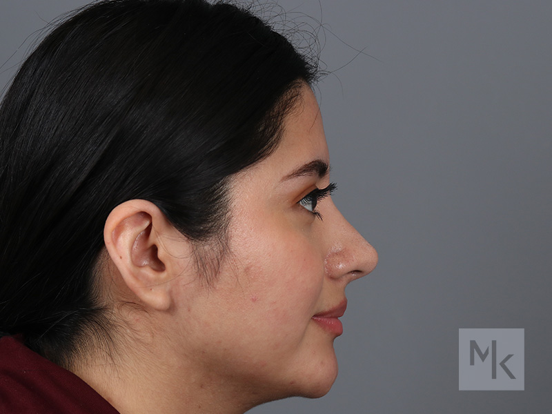 Rhinoplasty Before and After | Dr. Michael Kim