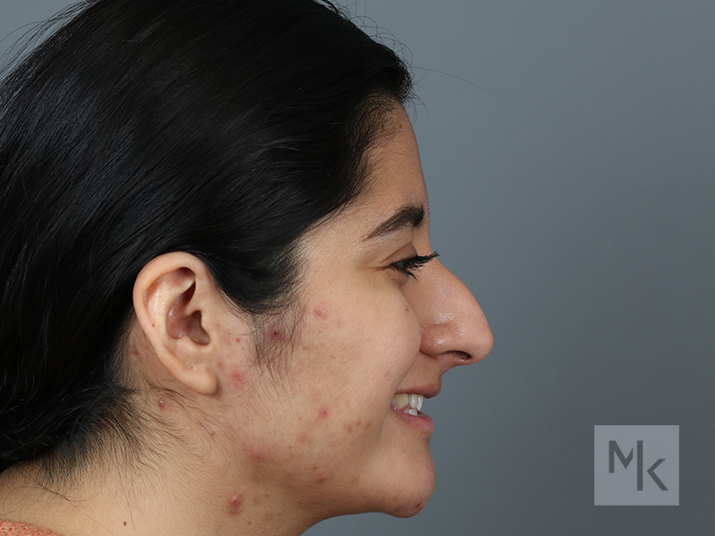 Rhinoplasty Before and After | Dr. Michael Kim