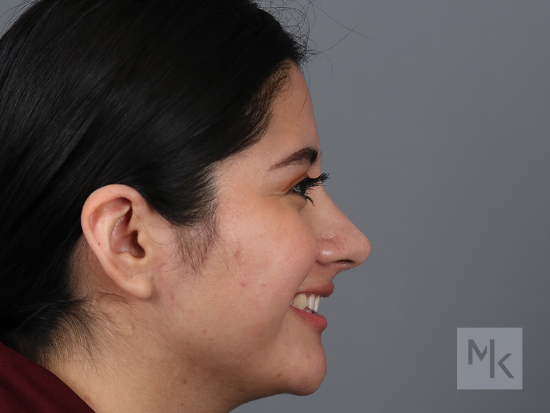 Rhinoplasty Before and After | Dr. Michael Kim