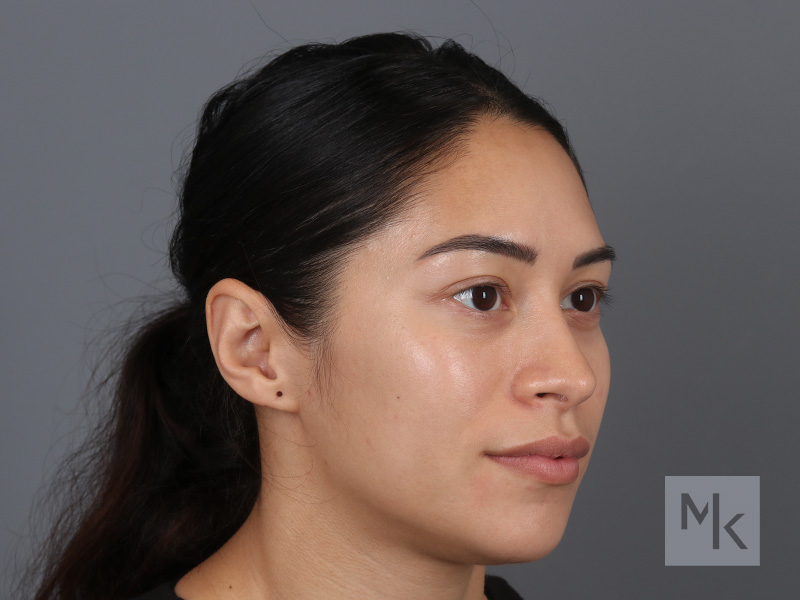 Rhinoplasty Before and After | Dr. Michael Kim