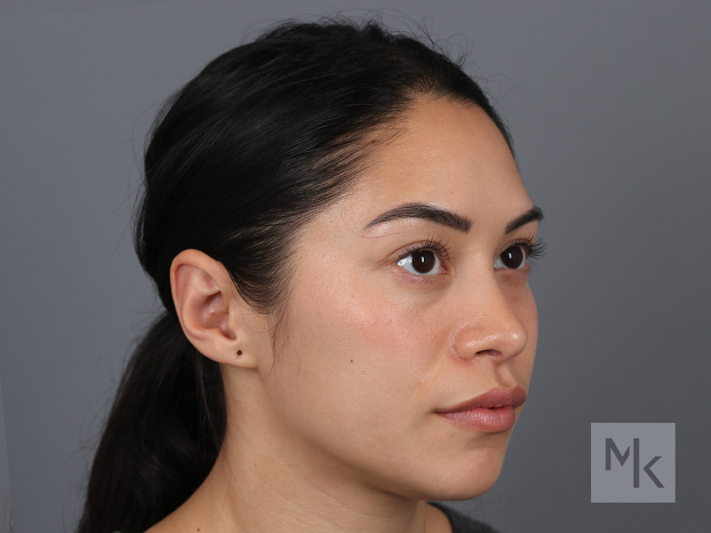 Rhinoplasty Before and After | Dr. Michael Kim