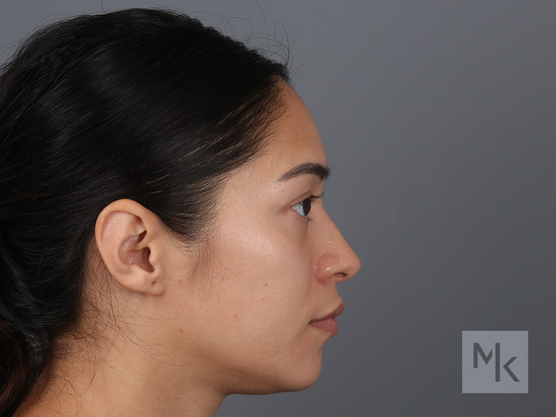 Rhinoplasty Before and After | Dr. Michael Kim