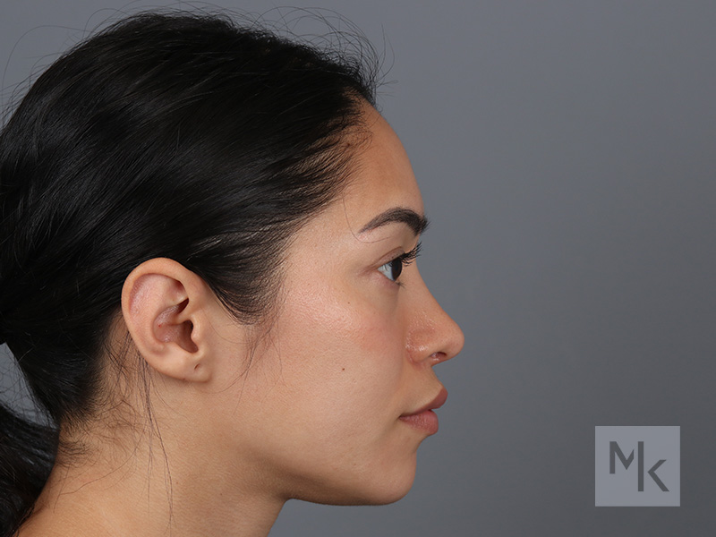 Rhinoplasty Before and After | Dr. Michael Kim