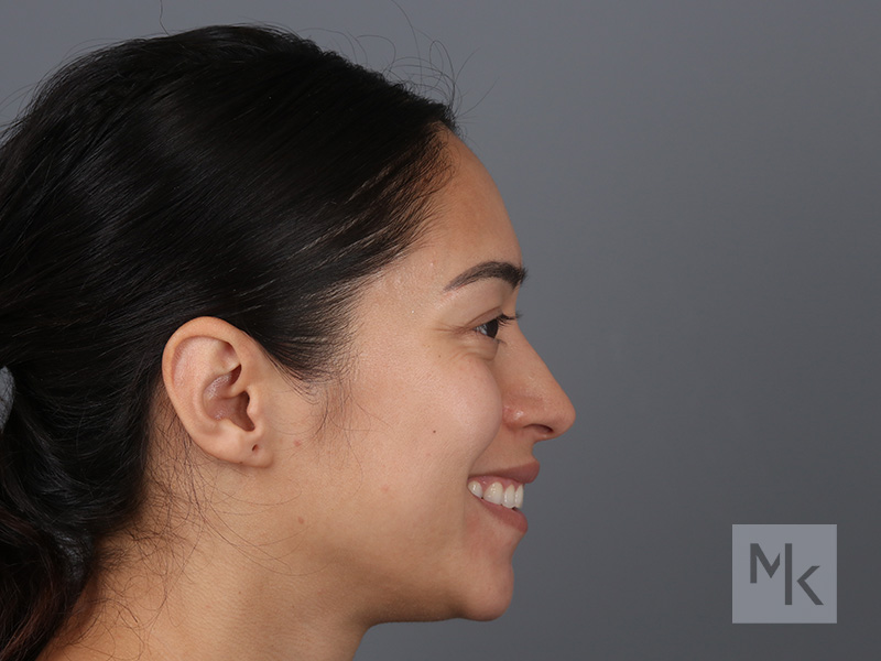 Rhinoplasty Before and After | Dr. Michael Kim