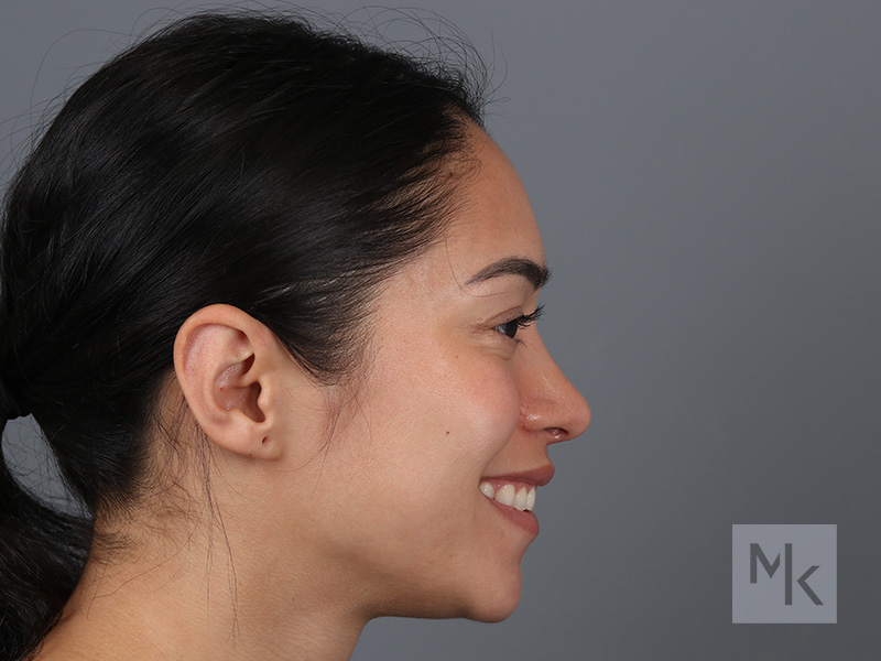 Rhinoplasty Before and After | Dr. Michael Kim