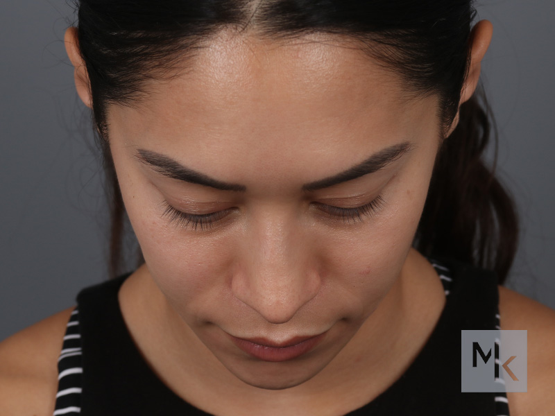 Rhinoplasty Before and After | Dr. Michael Kim