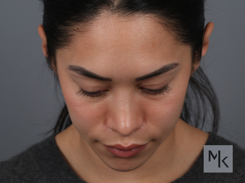 Rhinoplasty Before and After | Dr. Michael Kim