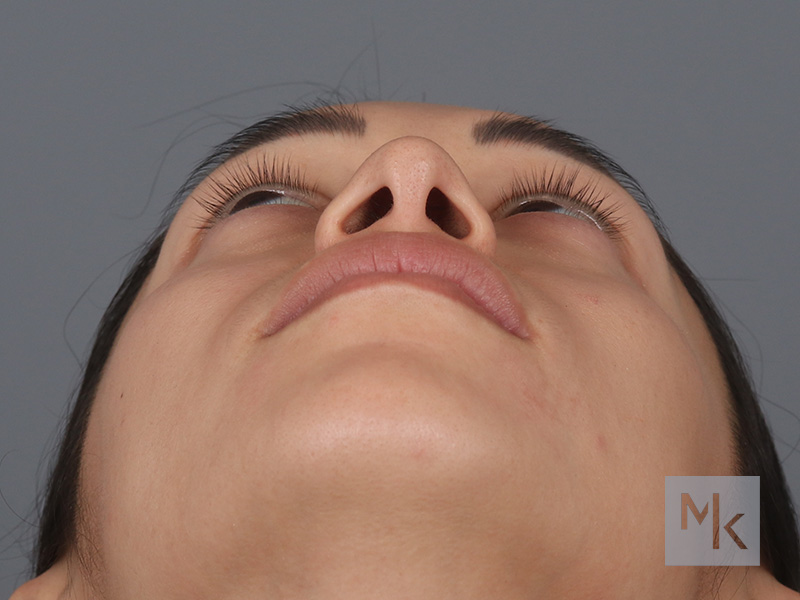 Rhinoplasty Before and After | Dr. Michael Kim