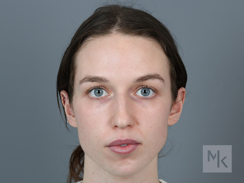 Rhinoplasty Before and After | Dr. Michael Kim