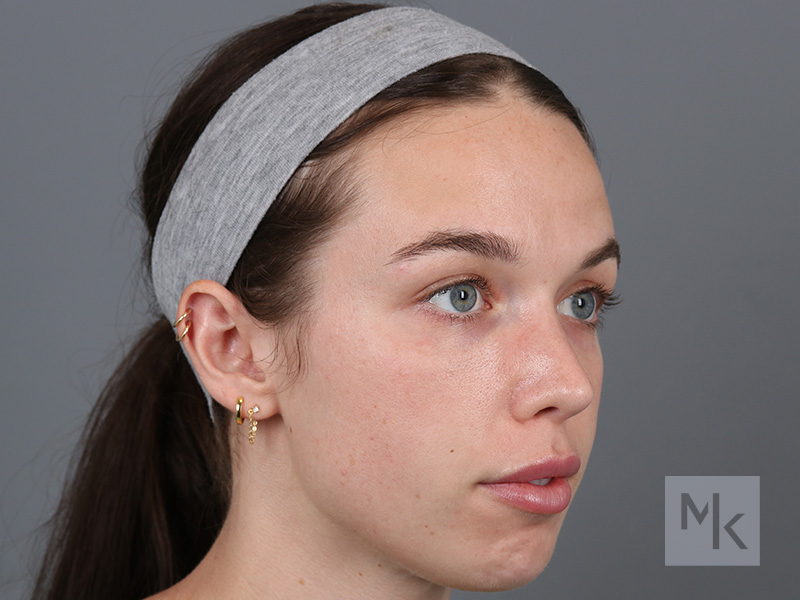 Rhinoplasty Before and After | Dr. Michael Kim