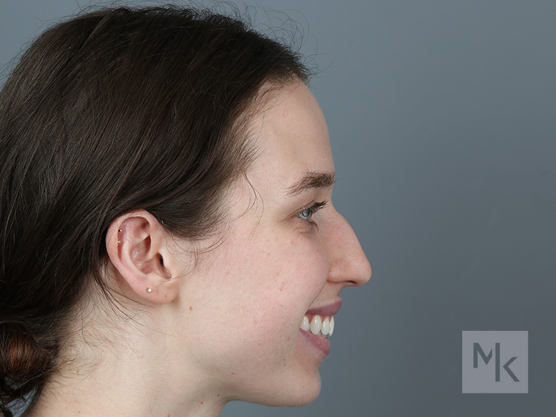 Rhinoplasty Before and After | Dr. Michael Kim