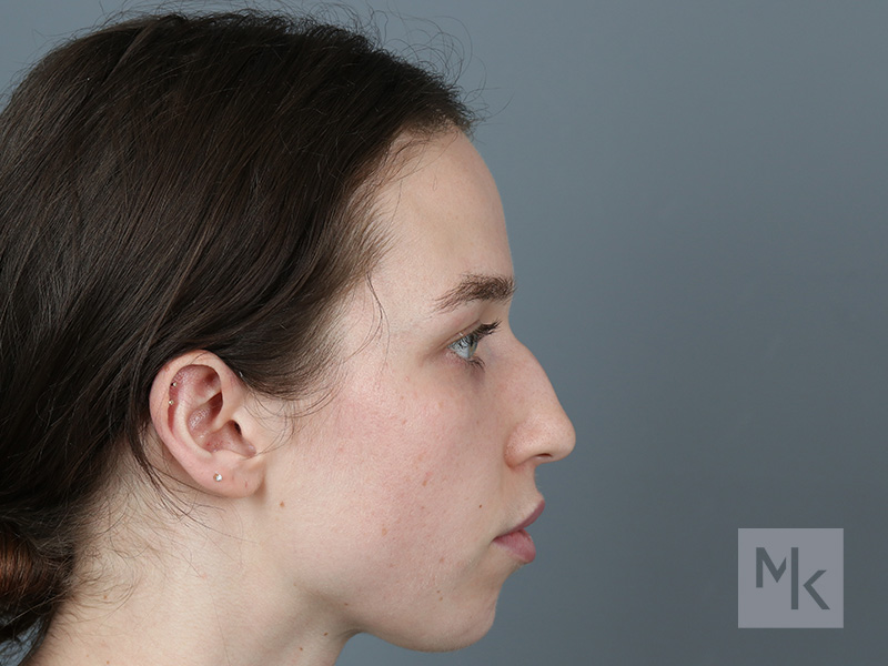 Rhinoplasty Before and After | Dr. Michael Kim