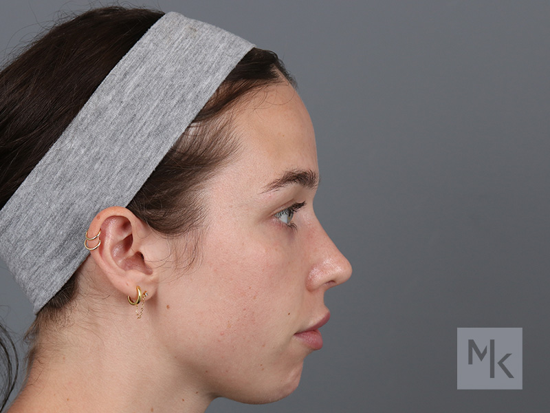 Rhinoplasty Before and After | Dr. Michael Kim