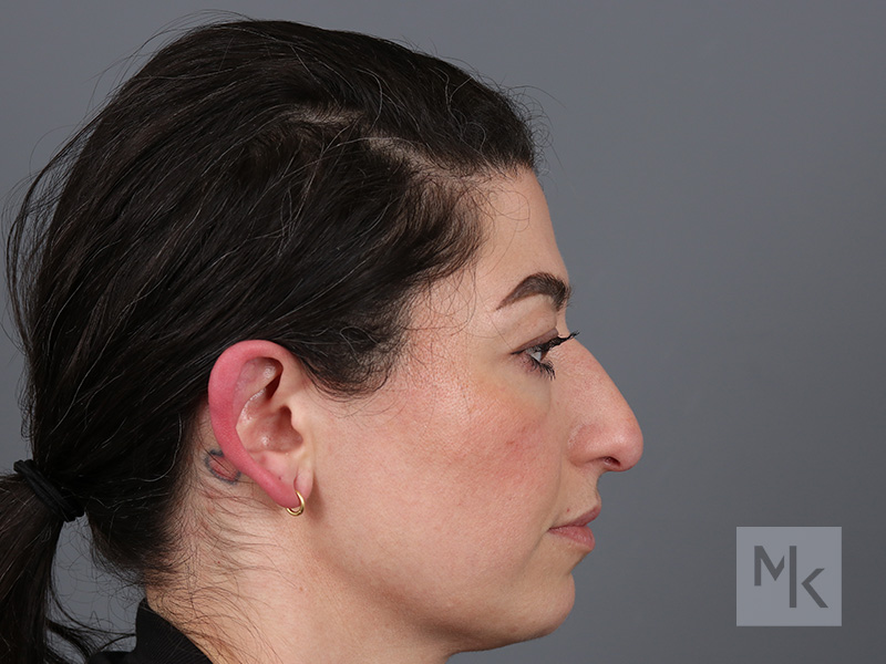 Rhinoplasty Before and After | Dr. Michael Kim