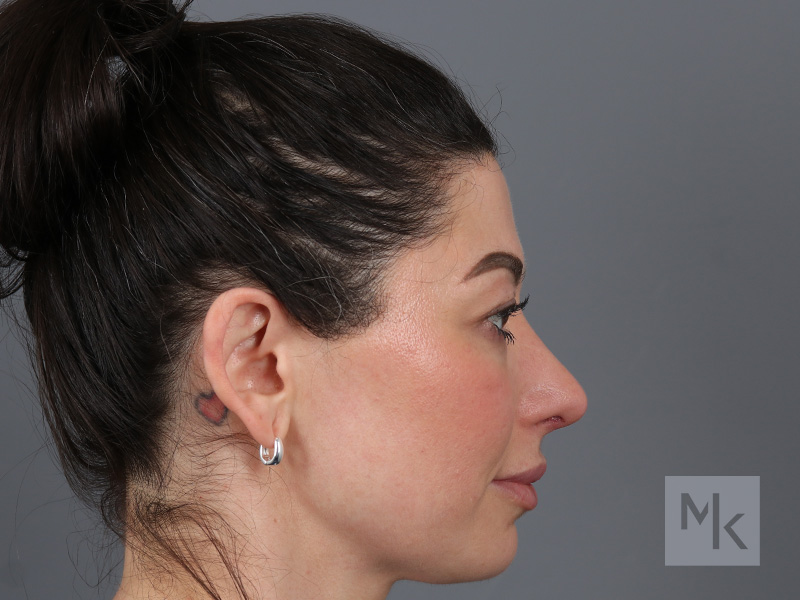 Rhinoplasty Before and After | Dr. Michael Kim