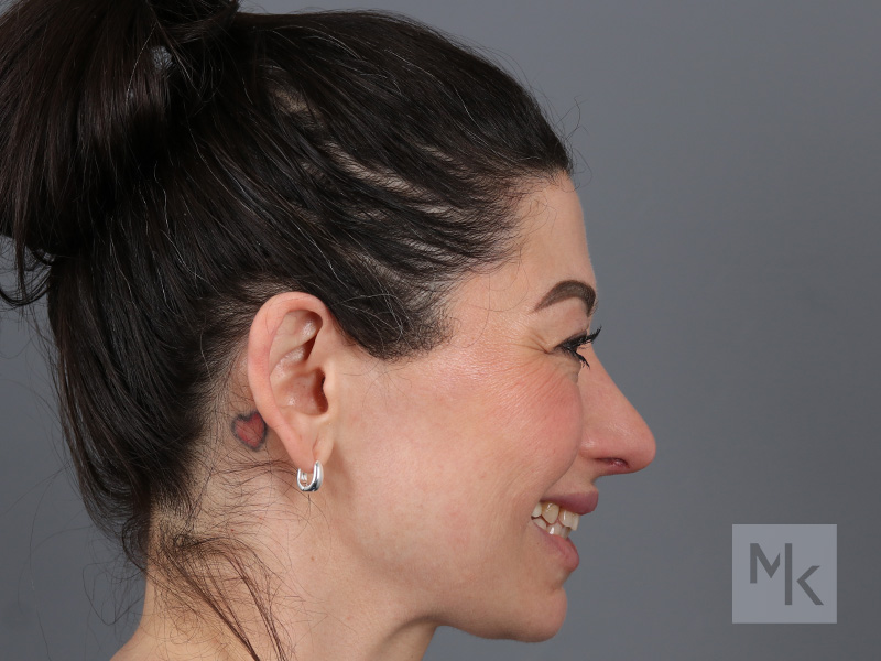 Rhinoplasty Before and After | Dr. Michael Kim