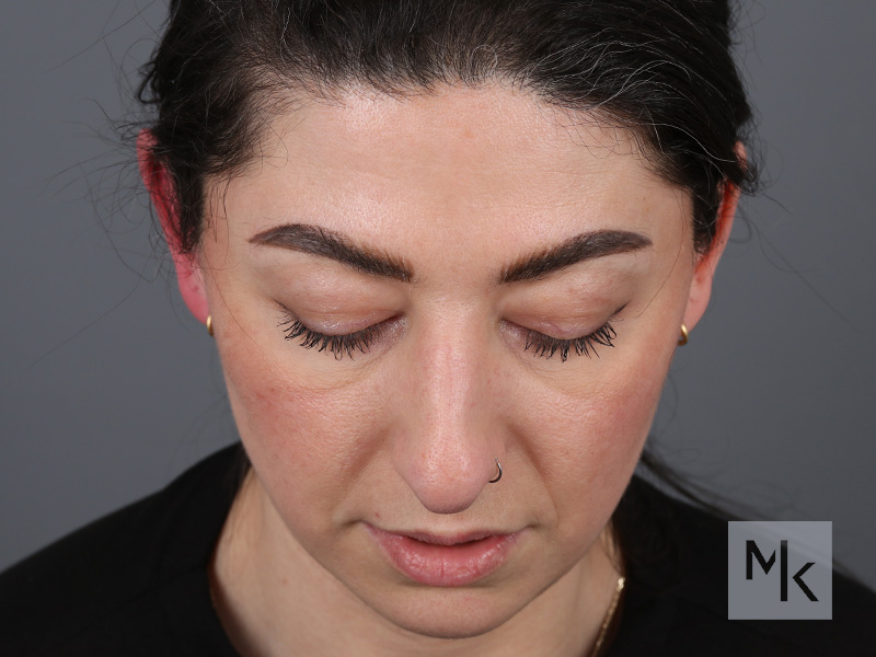 Rhinoplasty Before and After | Dr. Michael Kim