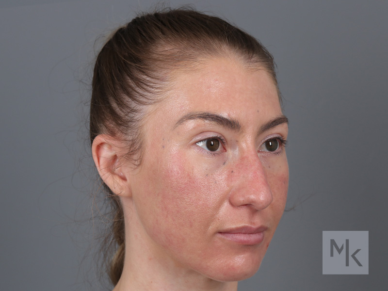 Rhinoplasty Before and After | Dr. Michael Kim