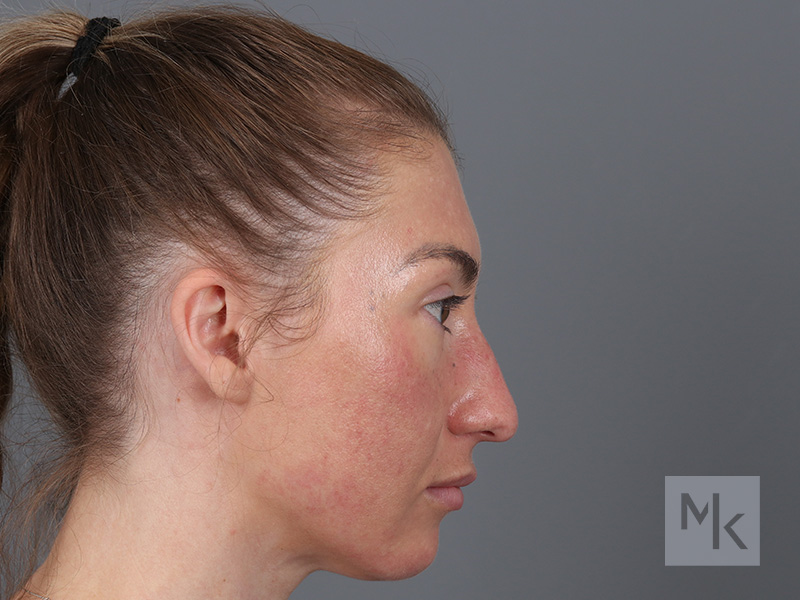 Rhinoplasty Before and After | Dr. Michael Kim